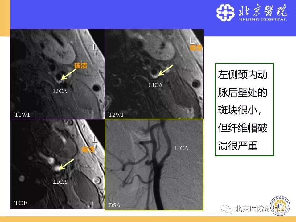 影像PPT - 【PPT】HRMRI在缺血性脑卒中精准病因诊断中的应用-11