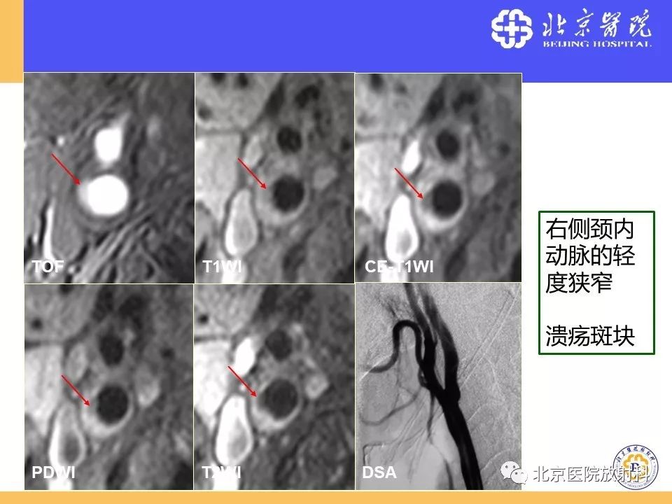 影像PPT - 【PPT】HRMRI在缺血性脑卒中精准病因诊断中的应用-13