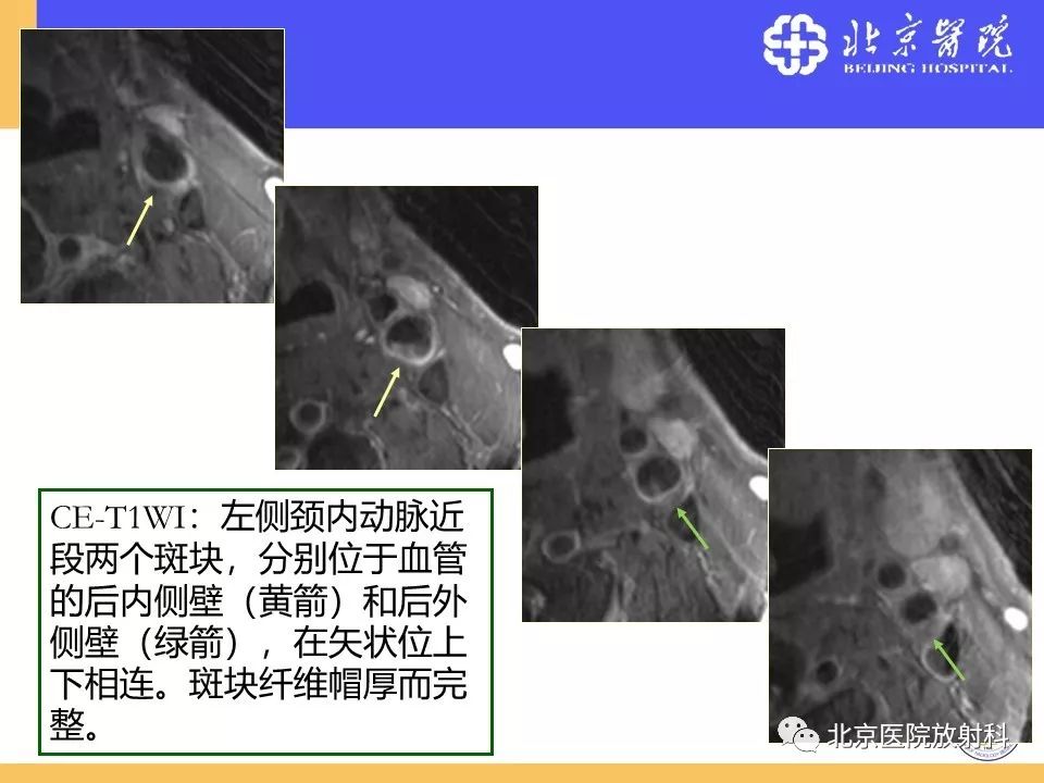 影像PPT - 【PPT】HRMRI在缺血性脑卒中精准病因诊断中的应用-16