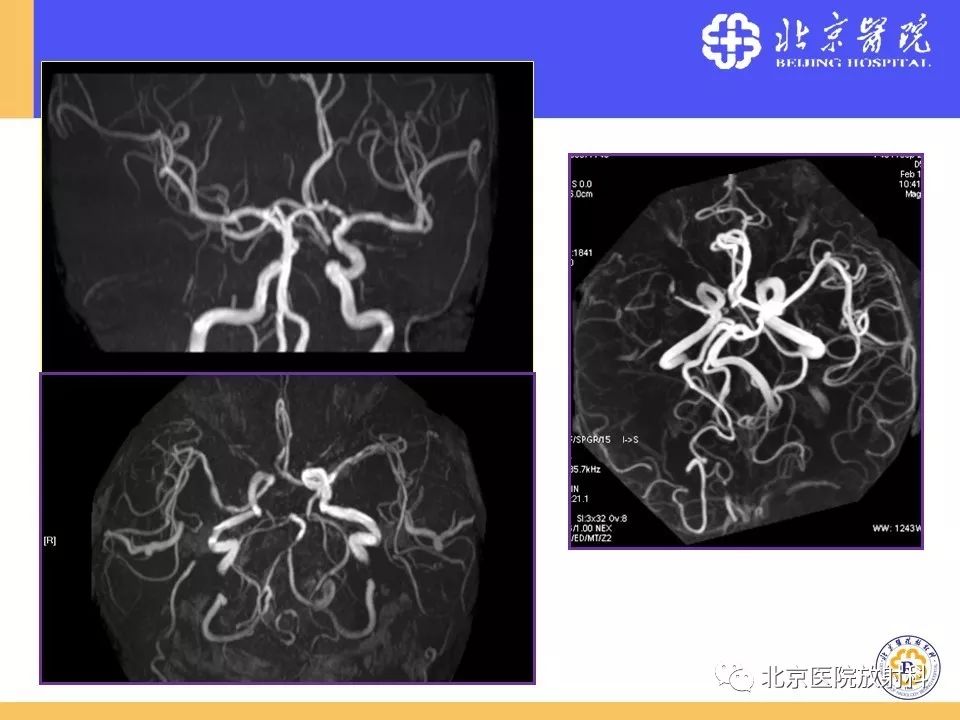 影像PPT - 【PPT】HRMRI在缺血性脑卒中精准病因诊断中的应用-18