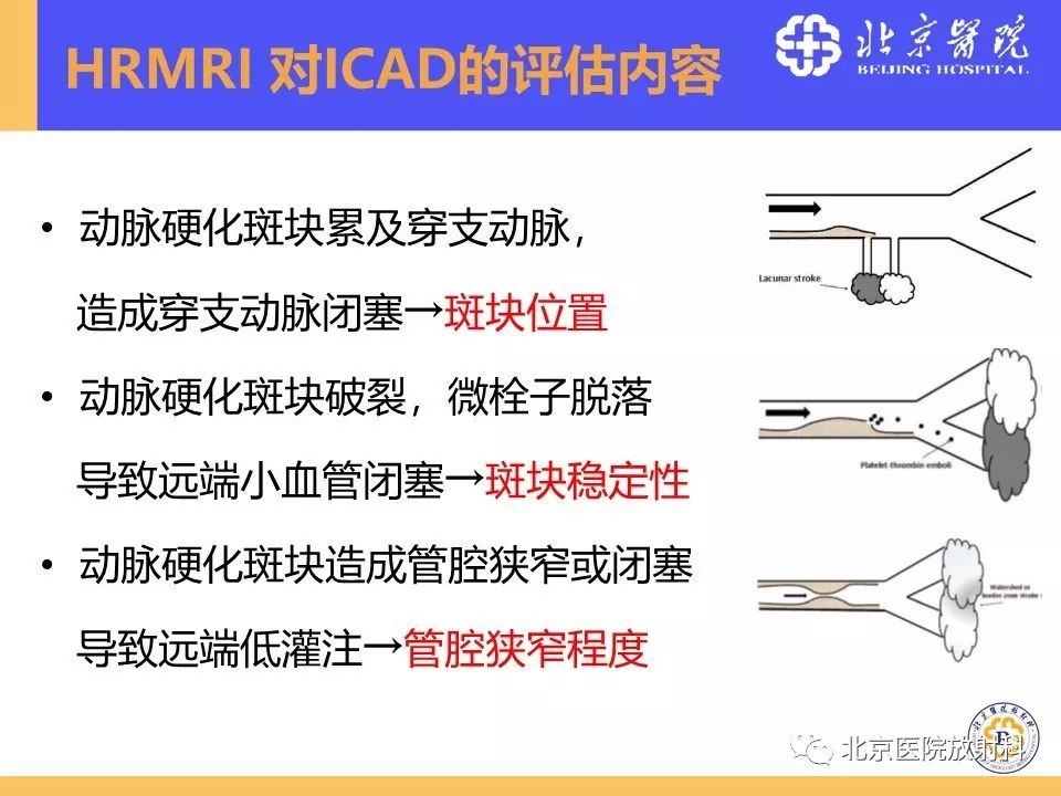 影像PPT - 【PPT】HRMRI在缺血性脑卒中精准病因诊断中的应用-20