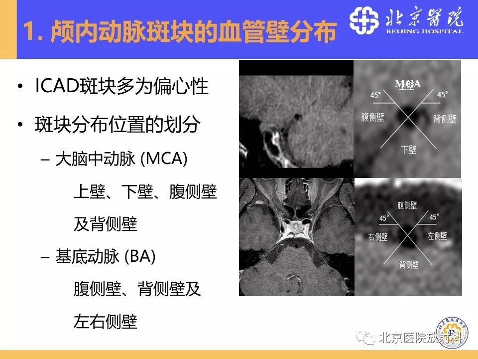 影像PPT - 【PPT】HRMRI在缺血性脑卒中精准病因诊断中的应用-22