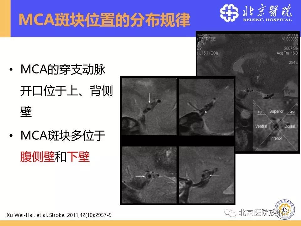 影像PPT - 【PPT】HRMRI在缺血性脑卒中精准病因诊断中的应用-23