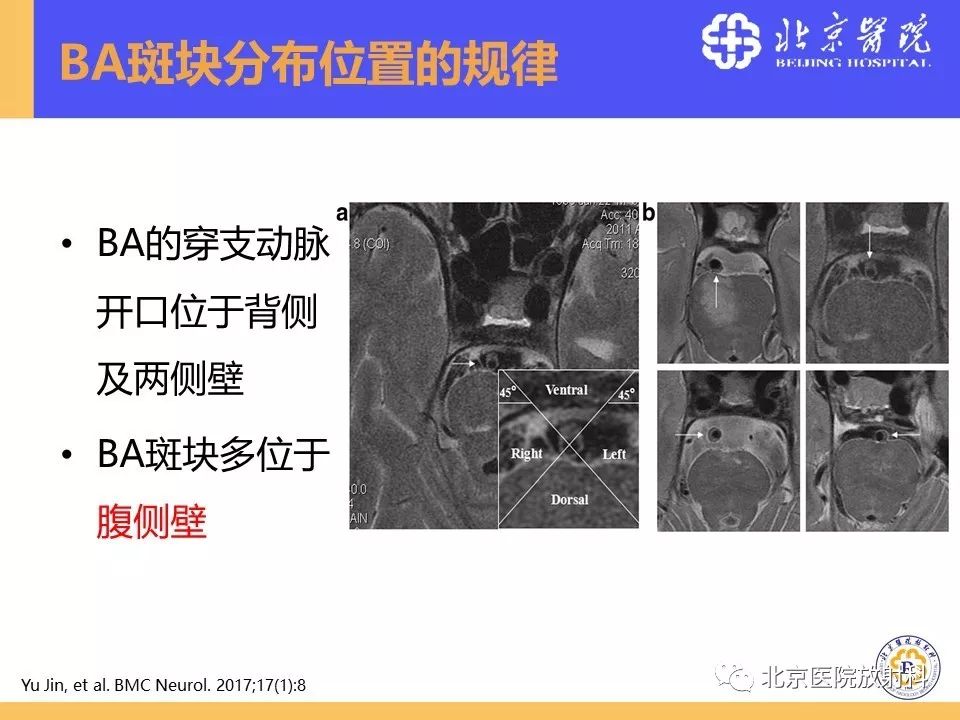 影像PPT - 【PPT】HRMRI在缺血性脑卒中精准病因诊断中的应用-24