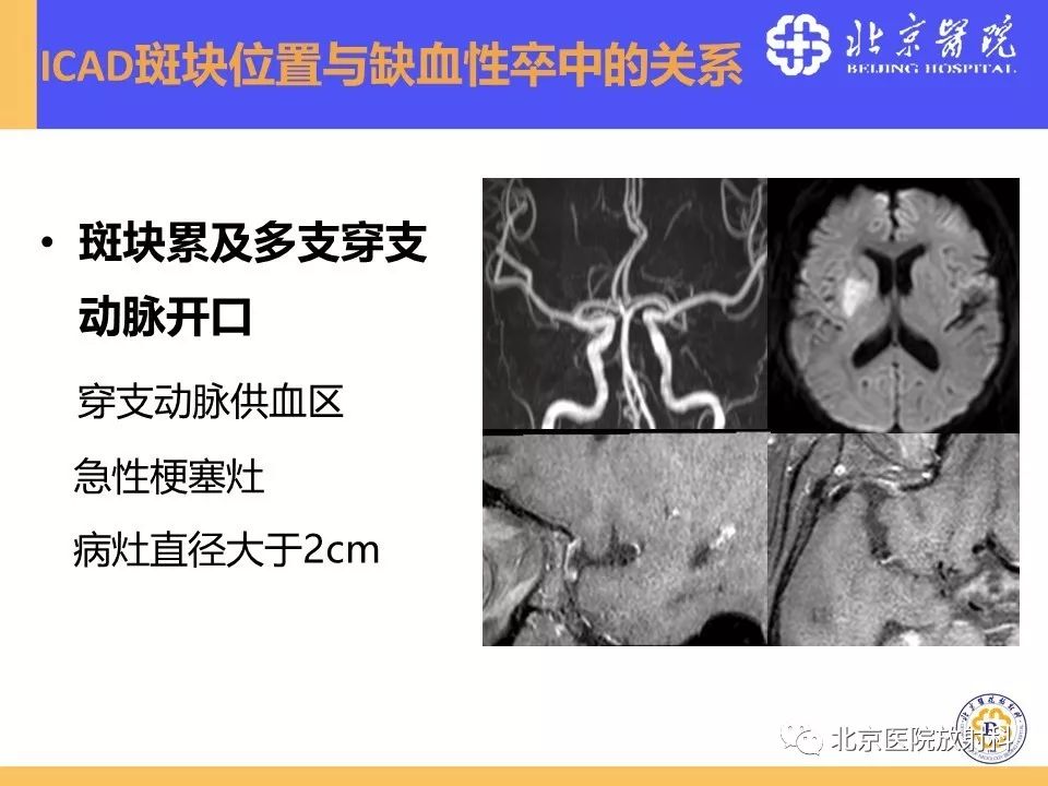 影像PPT - 【PPT】HRMRI在缺血性脑卒中精准病因诊断中的应用-27