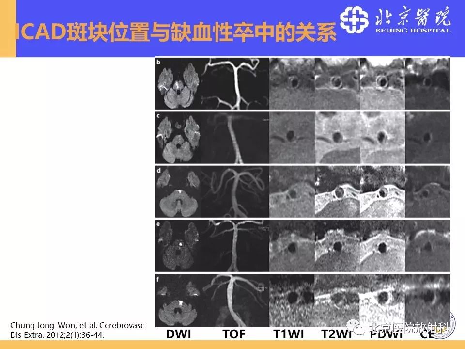 影像PPT - 【PPT】HRMRI在缺血性脑卒中精准病因诊断中的应用-28