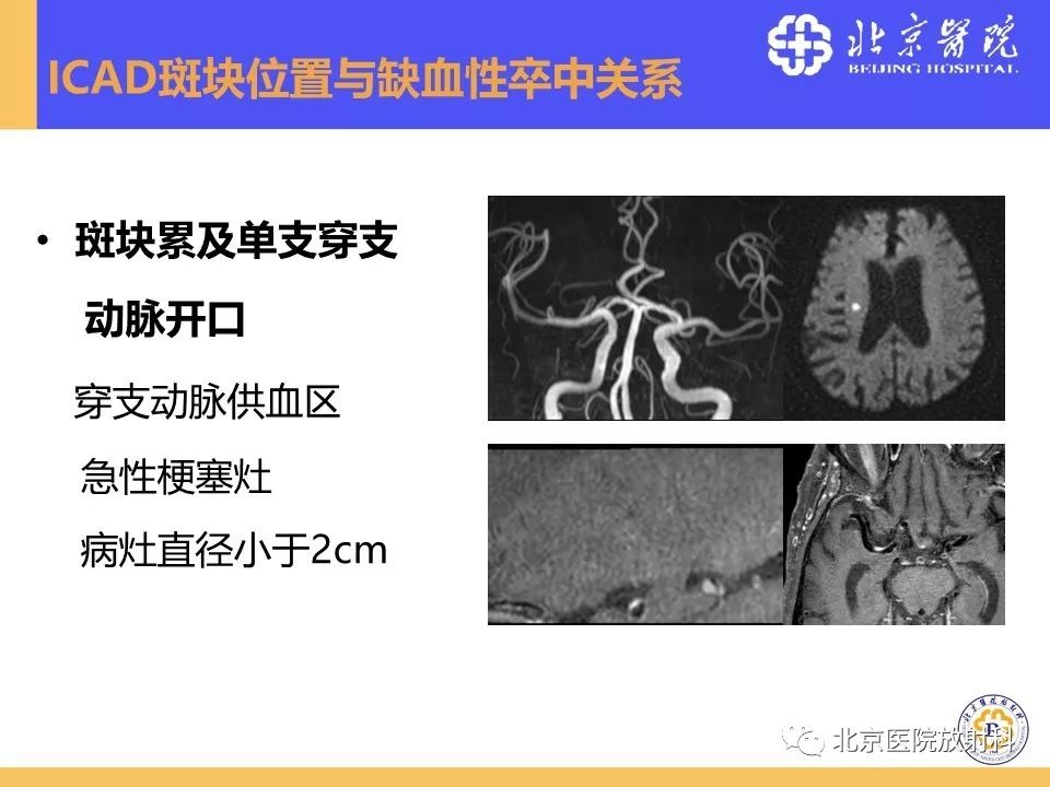 影像PPT - 【PPT】HRMRI在缺血性脑卒中精准病因诊断中的应用-26