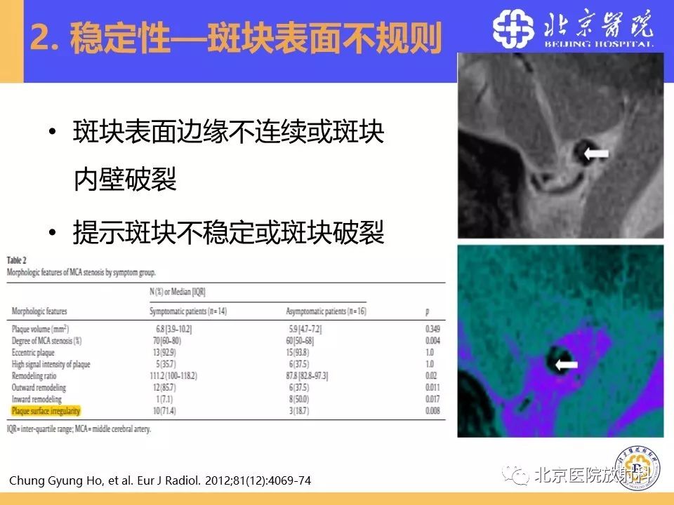 影像PPT - 【PPT】HRMRI在缺血性脑卒中精准病因诊断中的应用-30