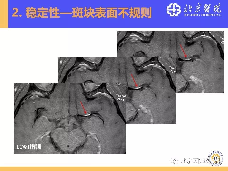 影像PPT - 【PPT】HRMRI在缺血性脑卒中精准病因诊断中的应用-31