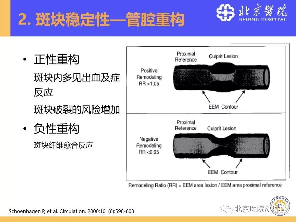 影像PPT - 【PPT】HRMRI在缺血性脑卒中精准病因诊断中的应用-32