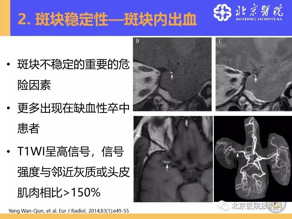影像PPT - 【PPT】HRMRI在缺血性脑卒中精准病因诊断中的应用-34