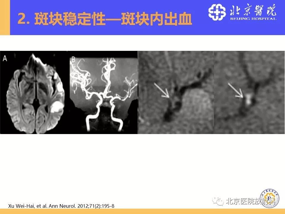 影像PPT - 【PPT】HRMRI在缺血性脑卒中精准病因诊断中的应用-35