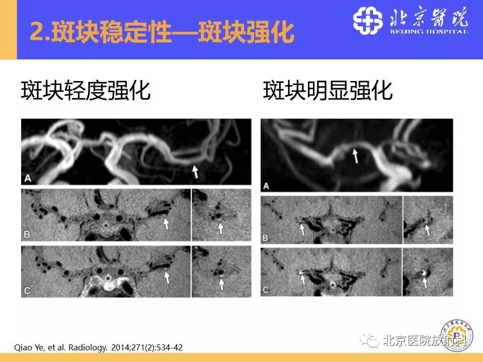 影像PPT - 【PPT】HRMRI在缺血性脑卒中精准病因诊断中的应用-38