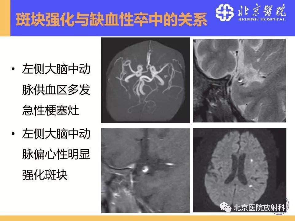 影像PPT - 【PPT】HRMRI在缺血性脑卒中精准病因诊断中的应用-42