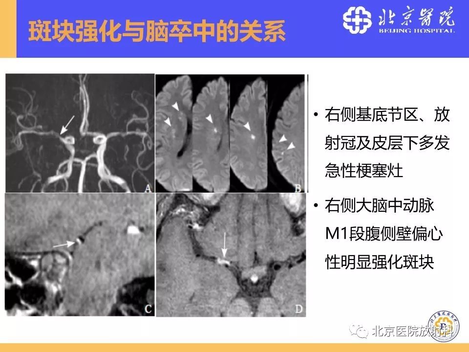 影像PPT - 【PPT】HRMRI在缺血性脑卒中精准病因诊断中的应用-43