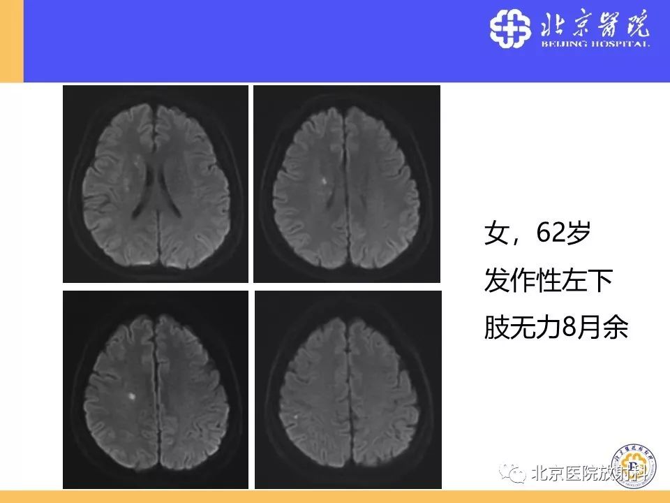 影像PPT - 【PPT】HRMRI在缺血性脑卒中精准病因诊断中的应用-46