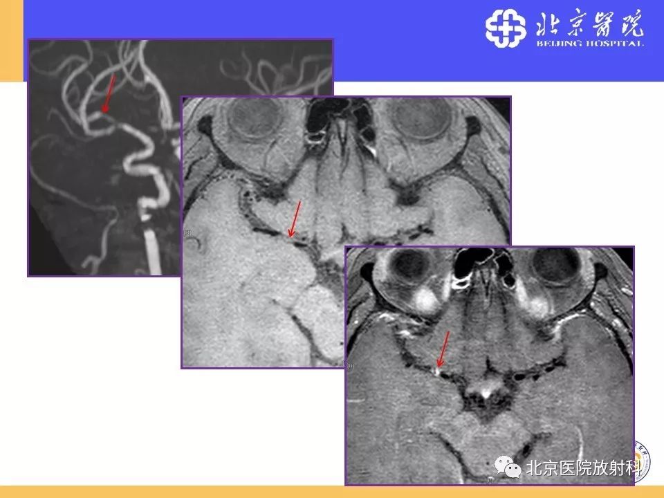 影像PPT - 【PPT】HRMRI在缺血性脑卒中精准病因诊断中的应用-47
