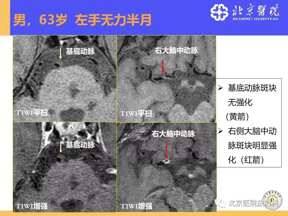 影像PPT - 【PPT】HRMRI在缺血性脑卒中精准病因诊断中的应用-48