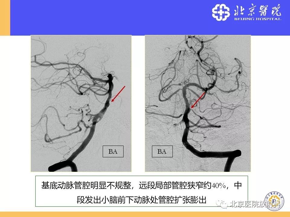 影像PPT - 【PPT】HRMRI在缺血性脑卒中精准病因诊断中的应用-50