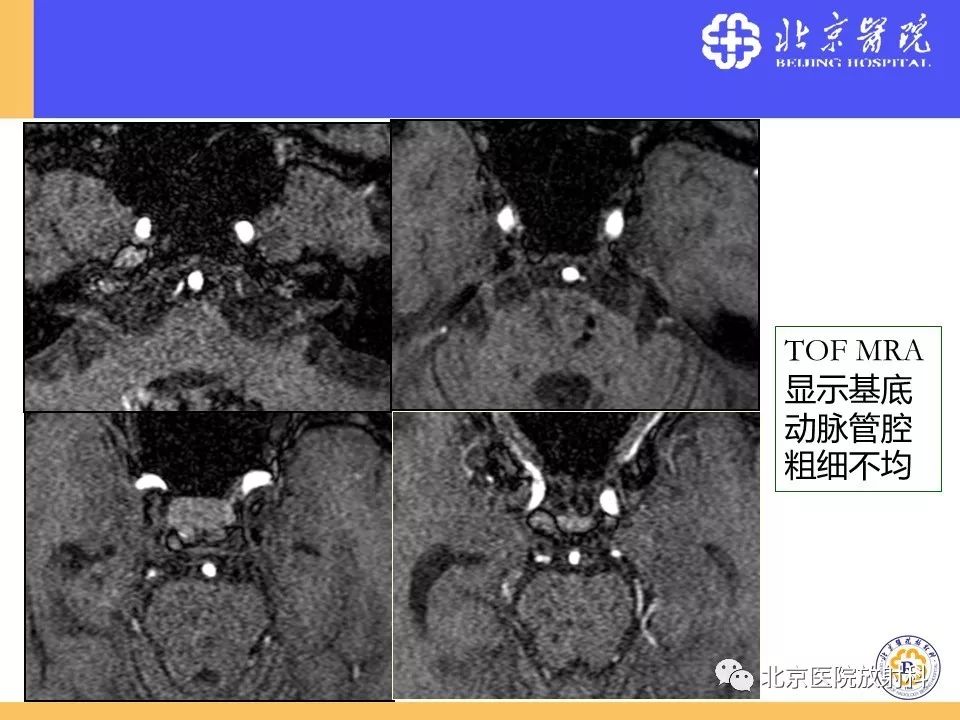 影像PPT - 【PPT】HRMRI在缺血性脑卒中精准病因诊断中的应用-51
