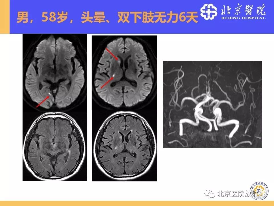 影像PPT - 【PPT】HRMRI在缺血性脑卒中精准病因诊断中的应用-53