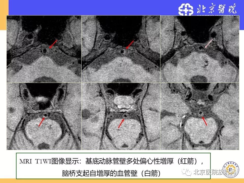 影像PPT - 【PPT】HRMRI在缺血性脑卒中精准病因诊断中的应用-52