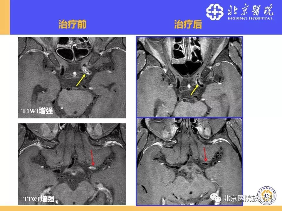 影像PPT - 【PPT】HRMRI在缺血性脑卒中精准病因诊断中的应用-58