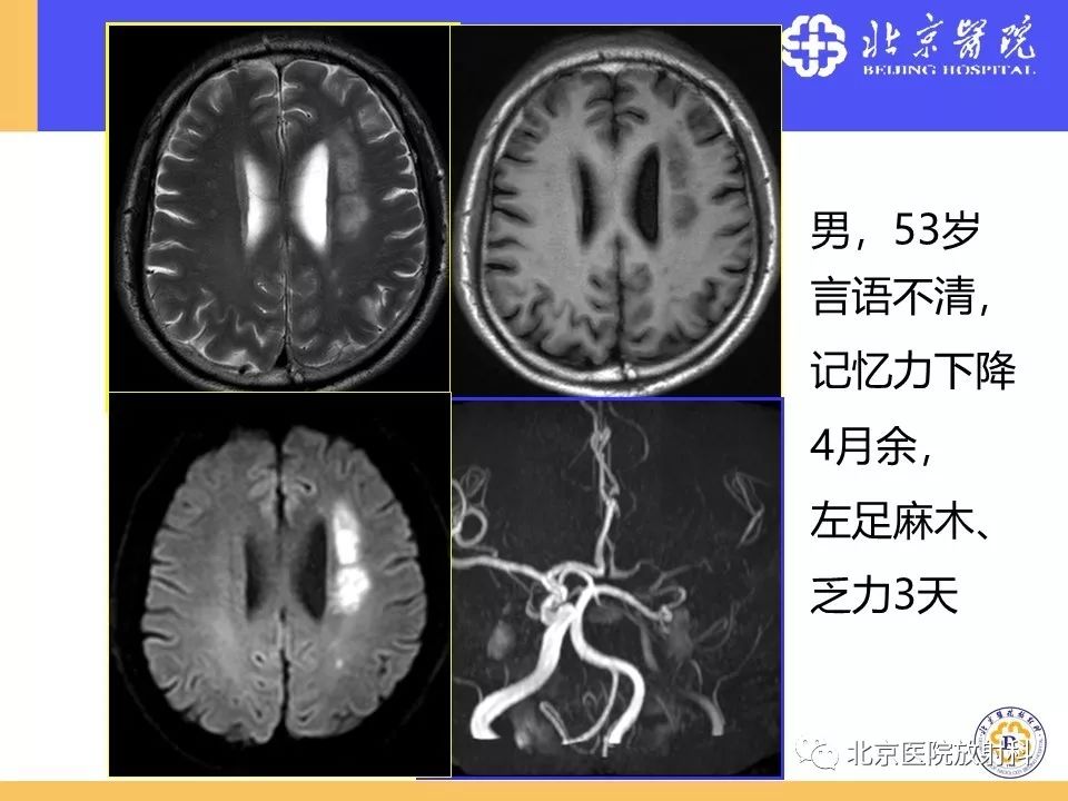 影像PPT - 【PPT】HRMRI在缺血性脑卒中精准病因诊断中的应用-57