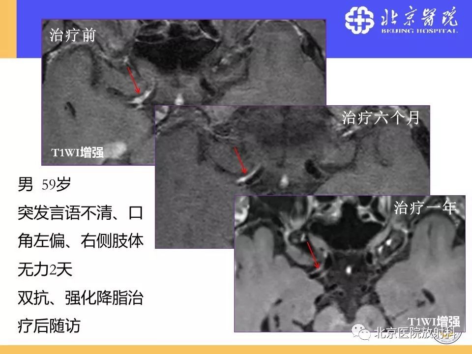 影像PPT - 【PPT】HRMRI在缺血性脑卒中精准病因诊断中的应用-59