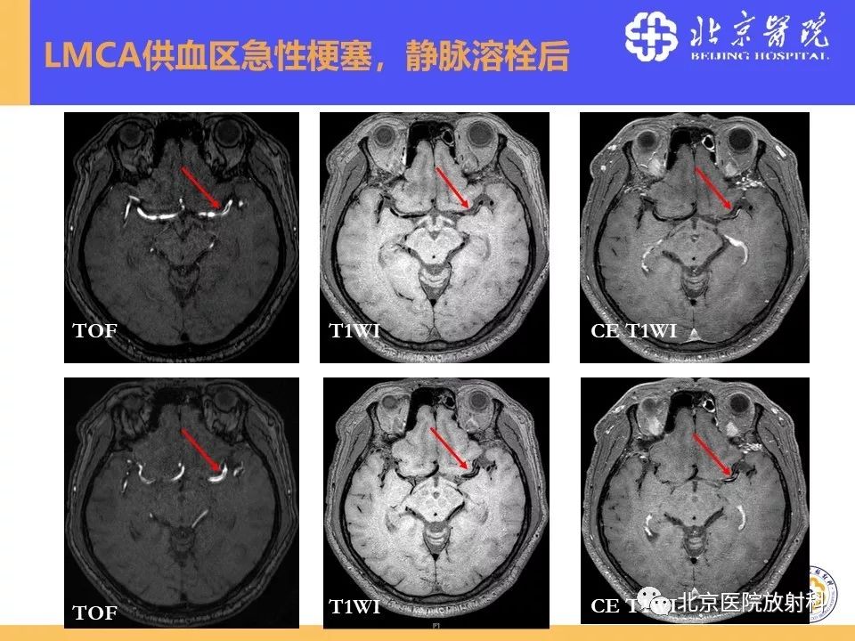 影像PPT - 【PPT】HRMRI在缺血性脑卒中精准病因诊断中的应用-61