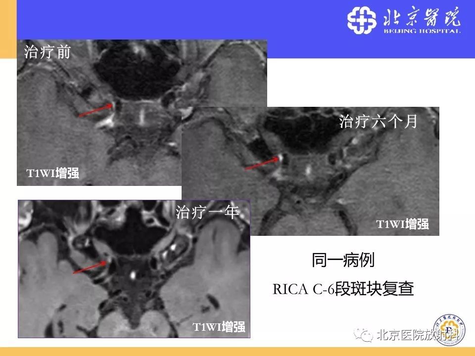 影像PPT - 【PPT】HRMRI在缺血性脑卒中精准病因诊断中的应用-60