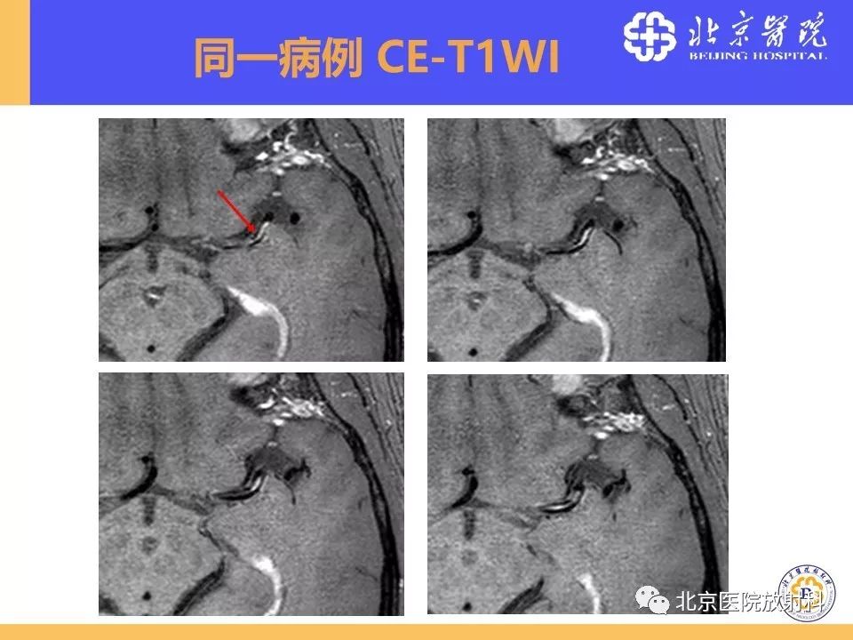影像PPT - 【PPT】HRMRI在缺血性脑卒中精准病因诊断中的应用-62