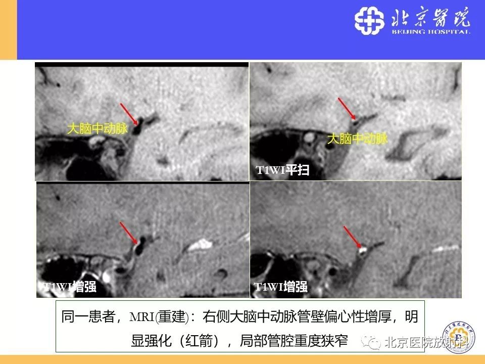 影像PPT - 【PPT】HRMRI在缺血性脑卒中精准病因诊断中的应用-66