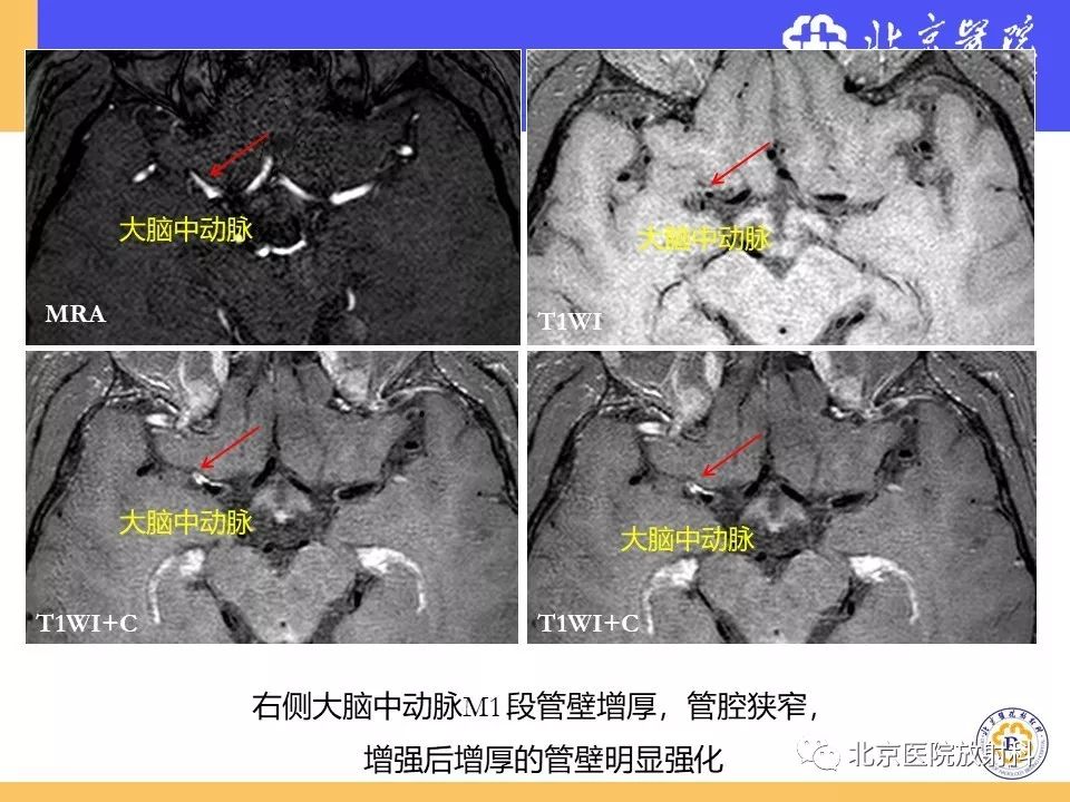 影像PPT - 【PPT】HRMRI在缺血性脑卒中精准病因诊断中的应用-65