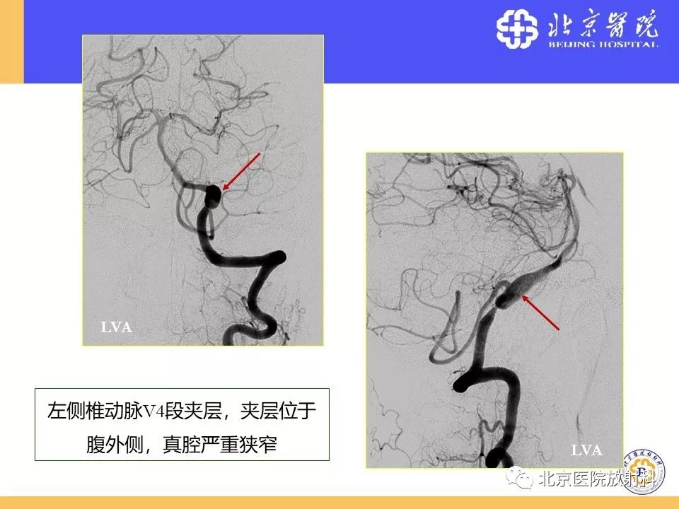 影像PPT - 【PPT】HRMRI在缺血性脑卒中精准病因诊断中的应用-69