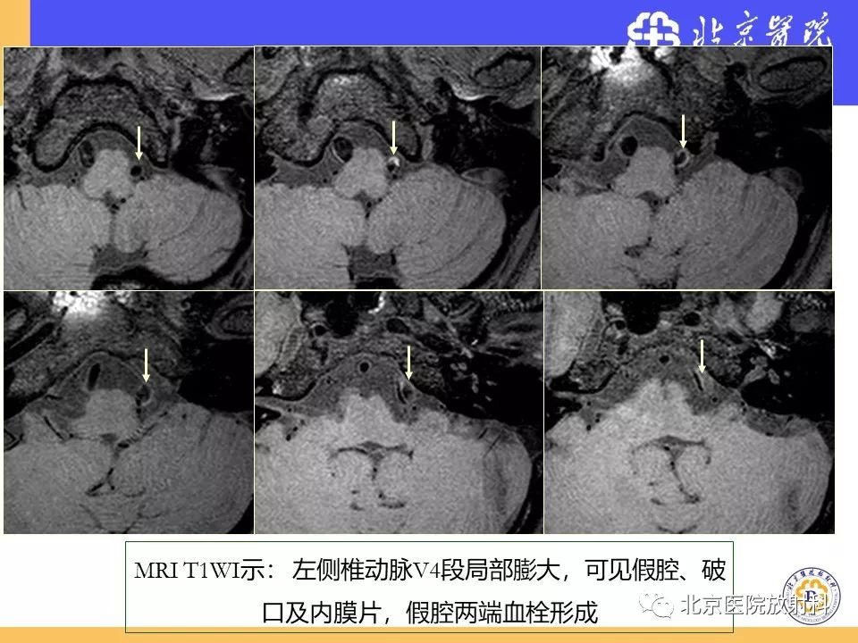 影像PPT - 【PPT】HRMRI在缺血性脑卒中精准病因诊断中的应用-68