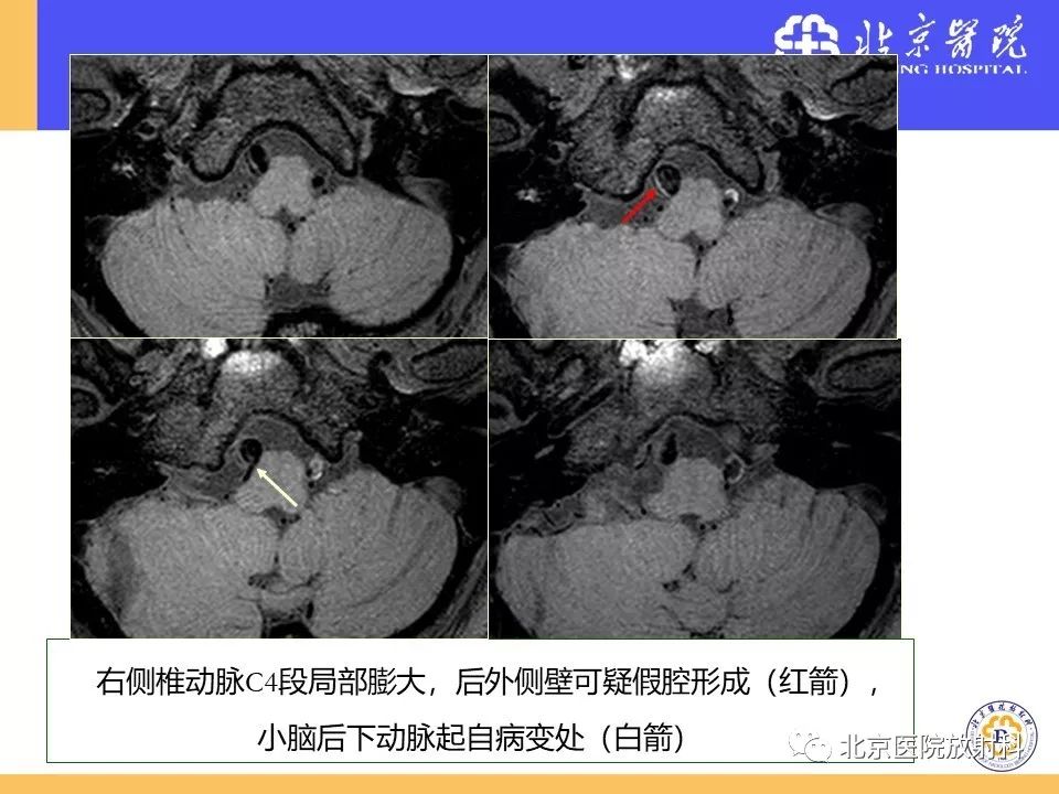 影像PPT - 【PPT】HRMRI在缺血性脑卒中精准病因诊断中的应用-71