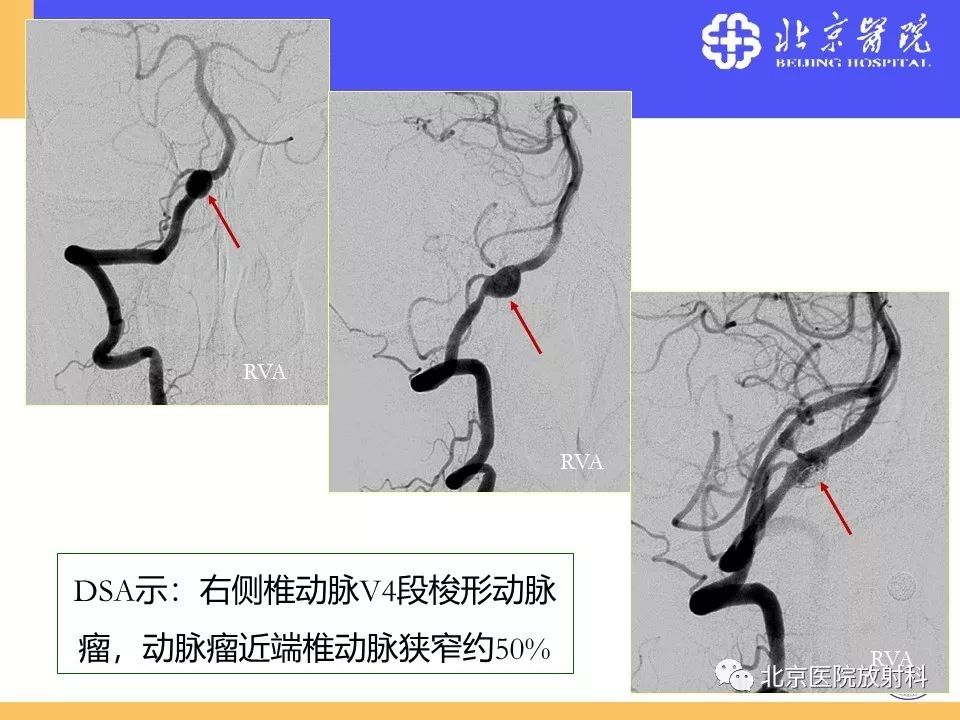 影像PPT - 【PPT】HRMRI在缺血性脑卒中精准病因诊断中的应用-72