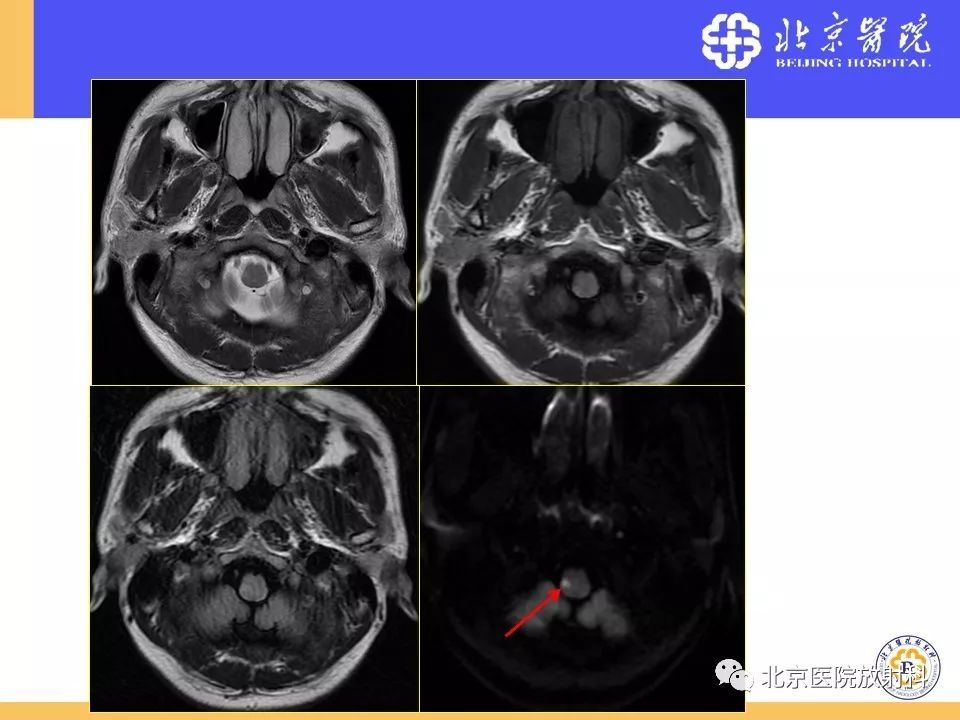 影像PPT - 【PPT】HRMRI在缺血性脑卒中精准病因诊断中的应用-73