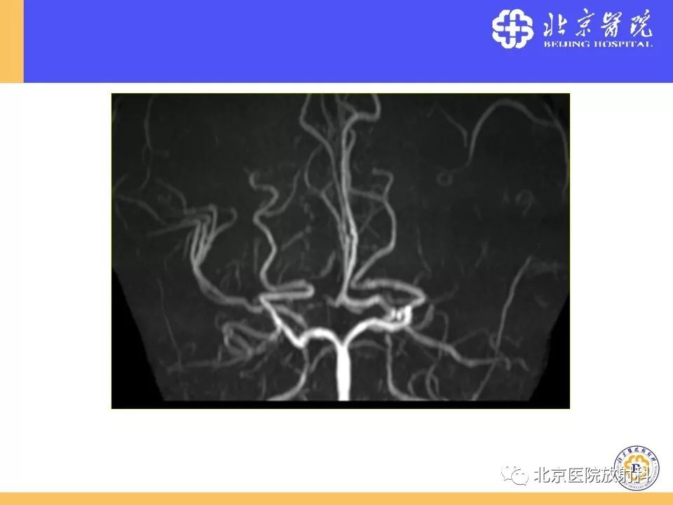 影像PPT - 【PPT】HRMRI在缺血性脑卒中精准病因诊断中的应用-76