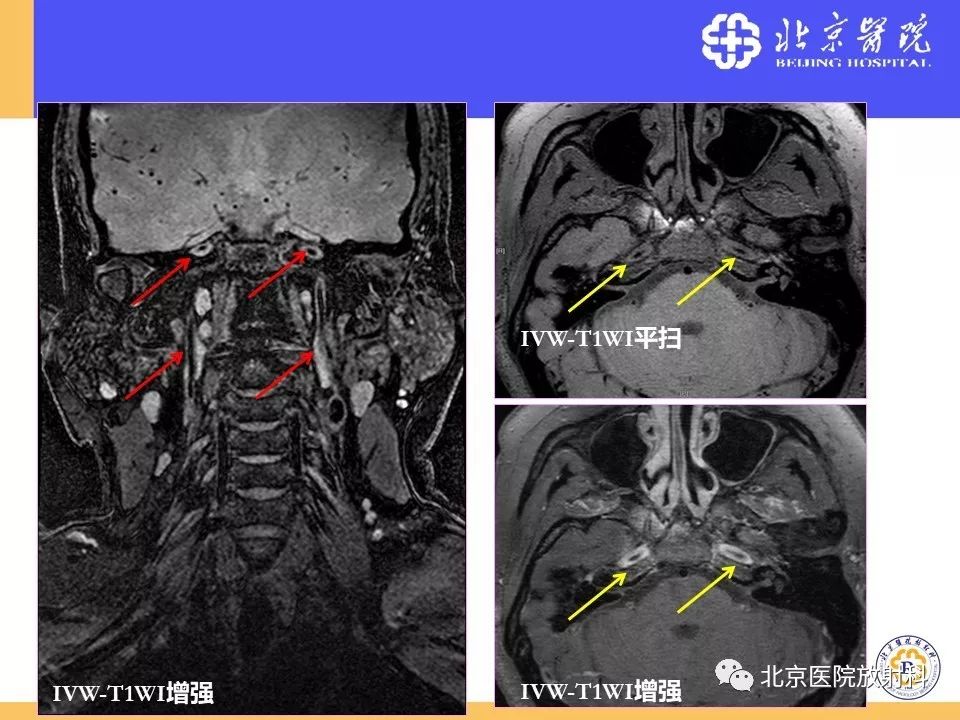 影像PPT - 【PPT】HRMRI在缺血性脑卒中精准病因诊断中的应用-77