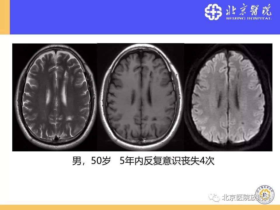 影像PPT - 【PPT】HRMRI在缺血性脑卒中精准病因诊断中的应用-80
