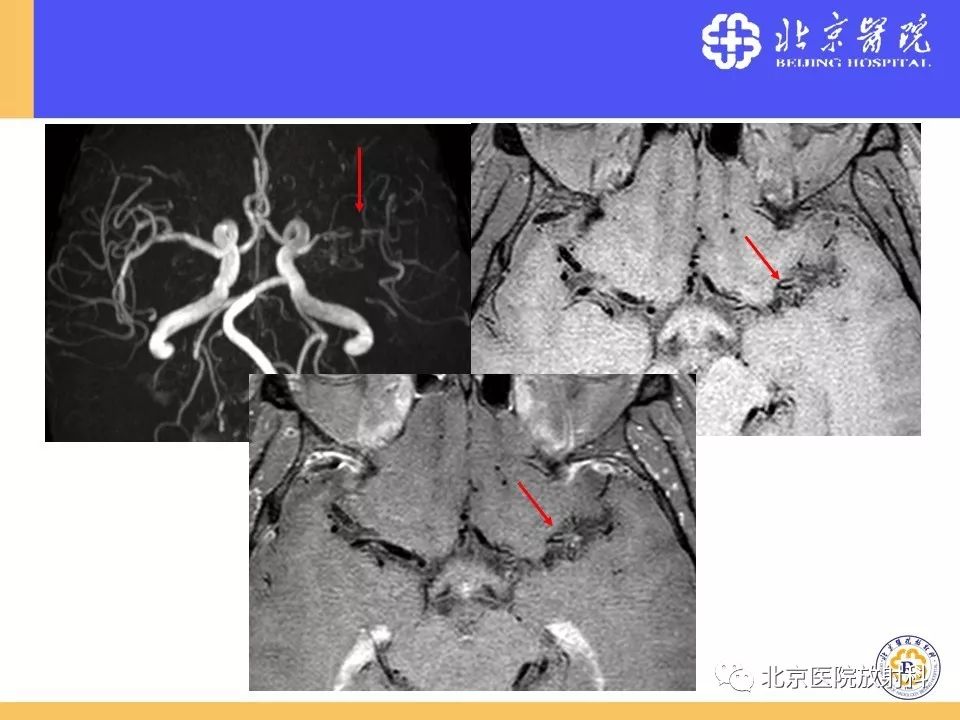 影像PPT - 【PPT】HRMRI在缺血性脑卒中精准病因诊断中的应用-81