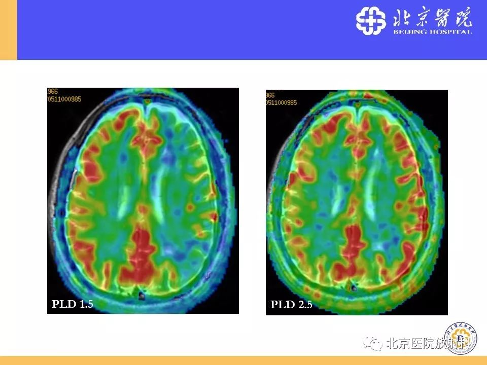 影像PPT - 【PPT】HRMRI在缺血性脑卒中精准病因诊断中的应用-82
