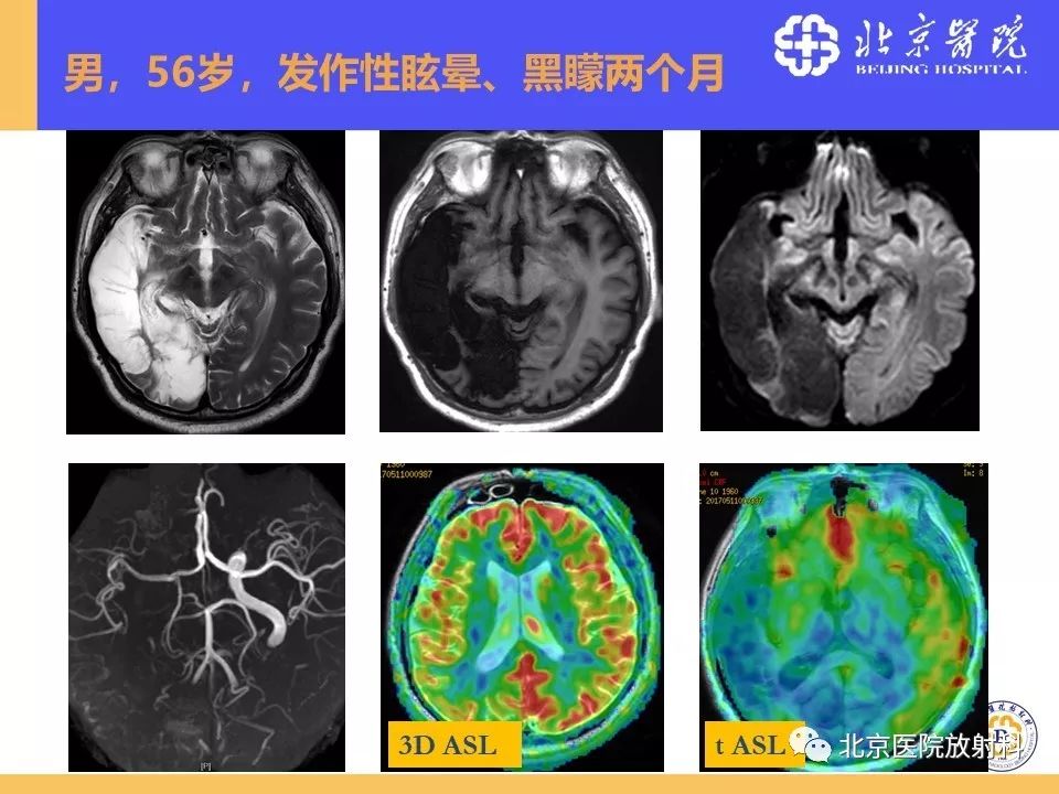 影像PPT - 【PPT】HRMRI在缺血性脑卒中精准病因诊断中的应用-83
