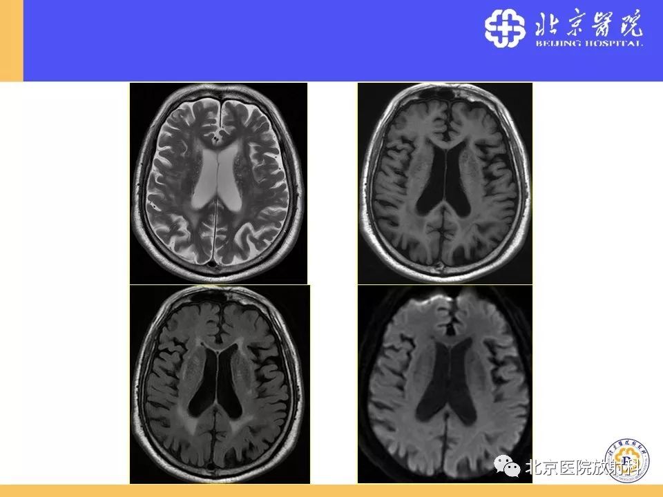 影像PPT - 【PPT】HRMRI在缺血性脑卒中精准病因诊断中的应用-84