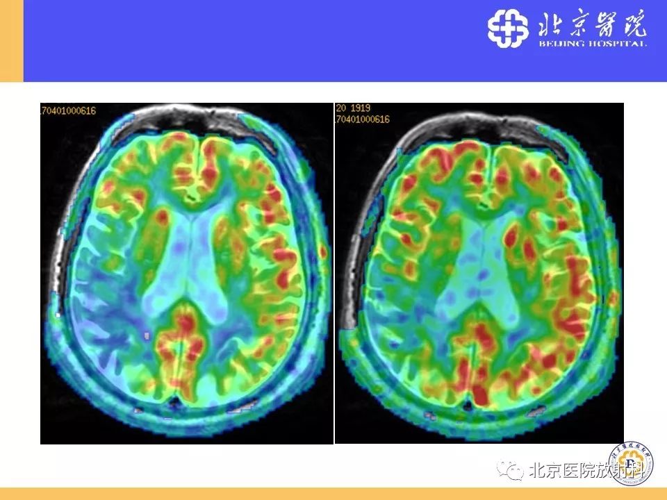 影像PPT - 【PPT】HRMRI在缺血性脑卒中精准病因诊断中的应用-85