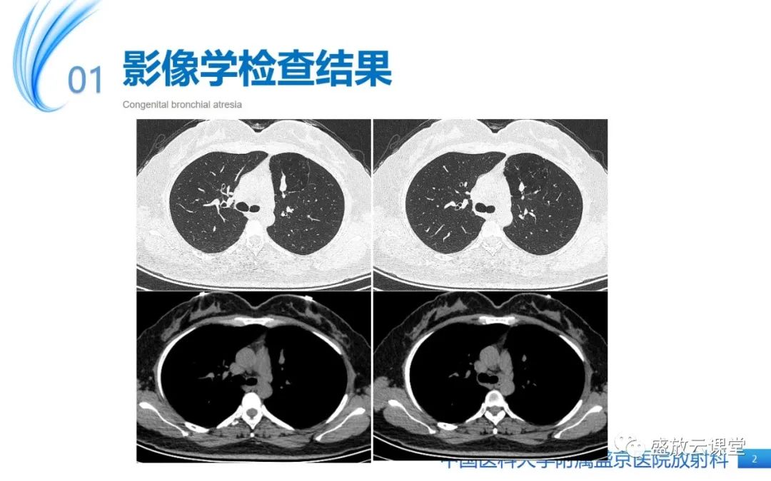 影像PPT - 【PPT】先天性支气管闭锁-2