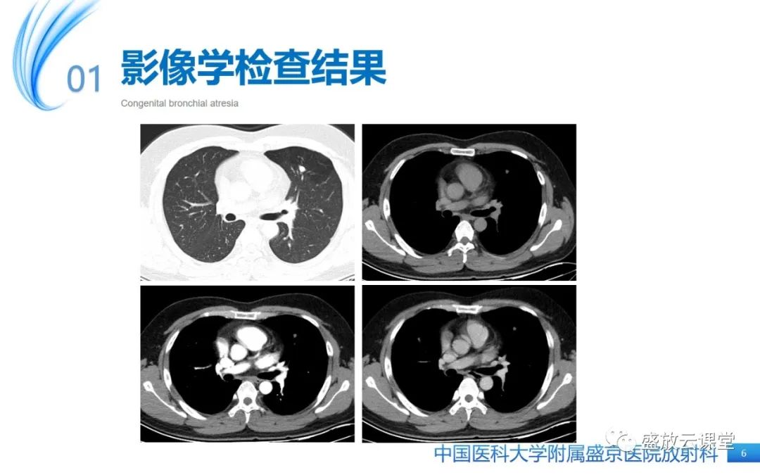 影像PPT - 【PPT】先天性支气管闭锁-6