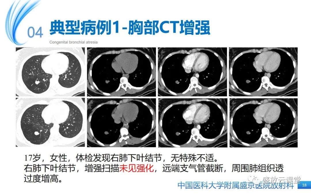 影像PPT - 【PPT】先天性支气管闭锁-17